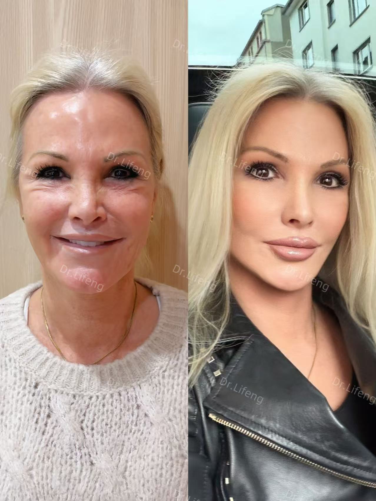 Dr. Li Feng SMAS Deep Lift Before and After 6 Months