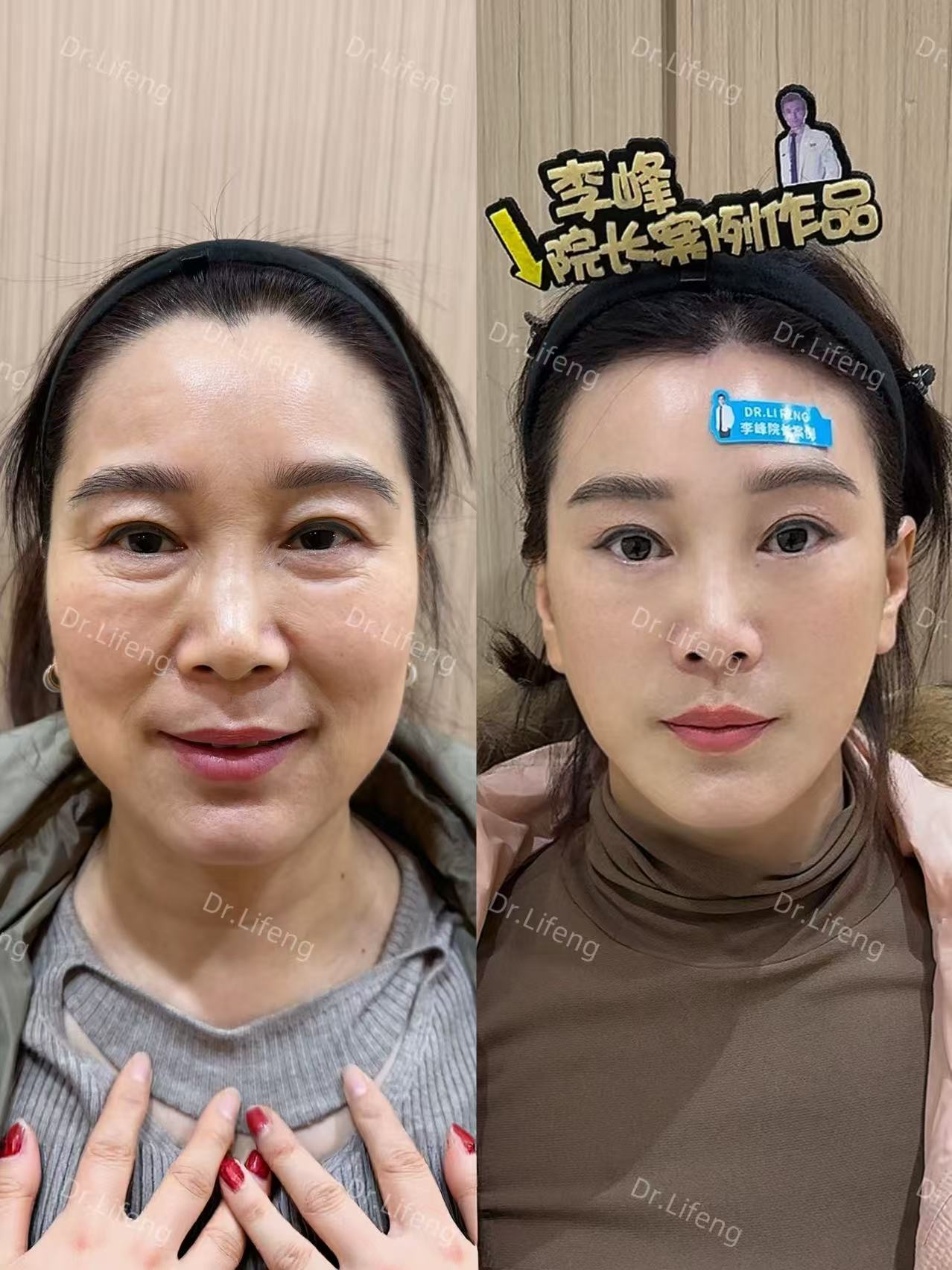 Dr. Li Feng Mid-Lower Face Lift Before and After 8 Months
