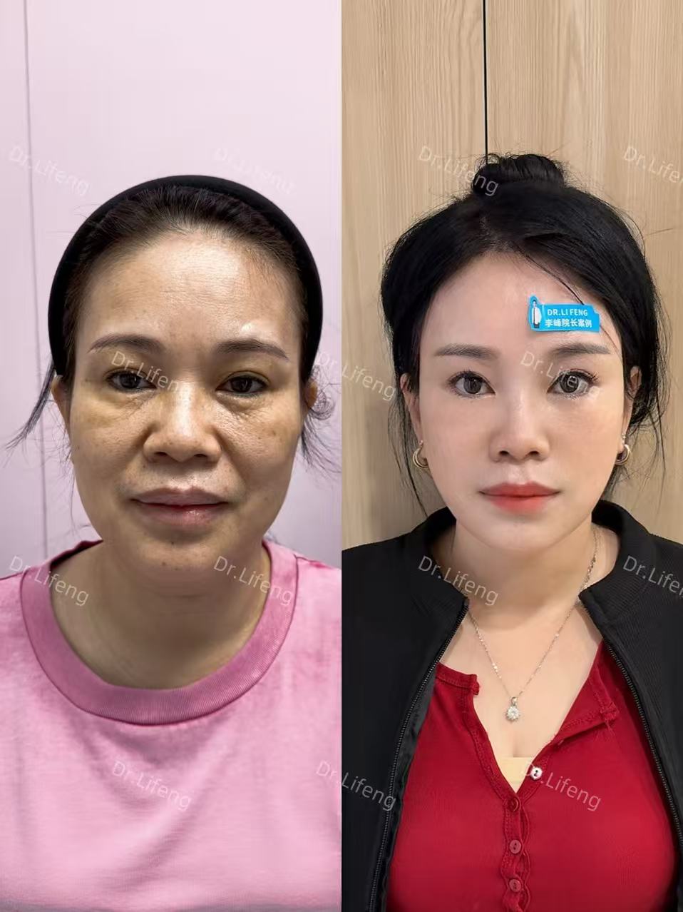 Dr. Li Feng Periorbital Rejuvenation Before and After 4 Months