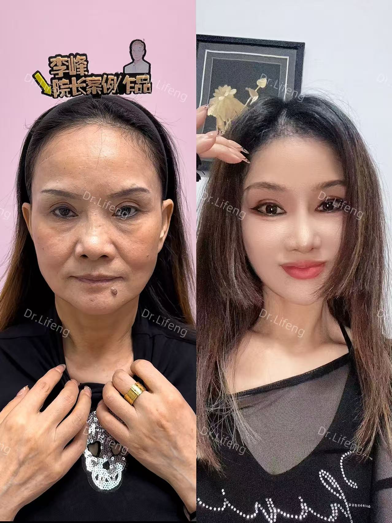 Dr. Li Feng SMAS Deep Lift Before and After 5 Months