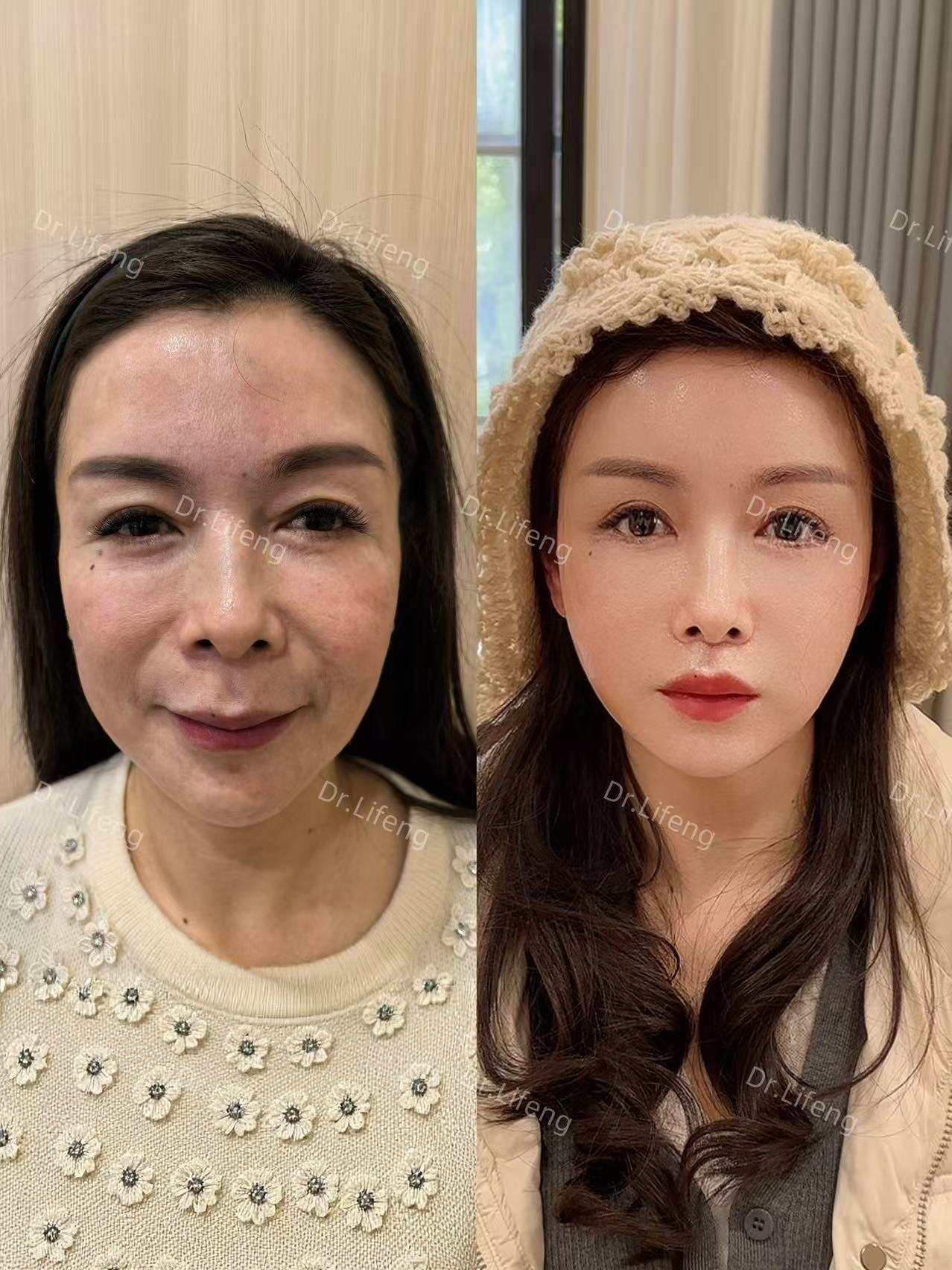 Dr. Li Feng Mid-Lower Face Lift Before and After 6 Months