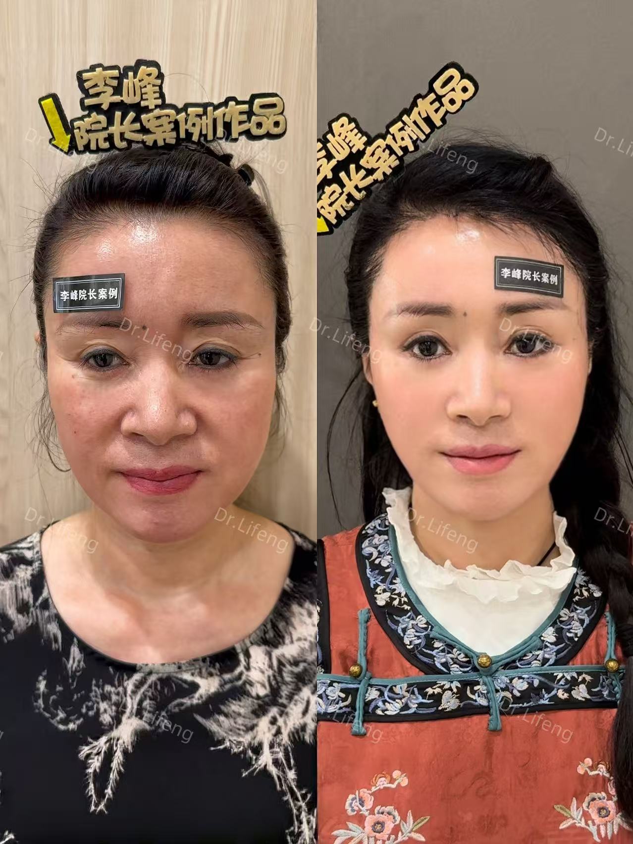 Dr. Li Feng SMAS Deep Lift Before and After 12 Months