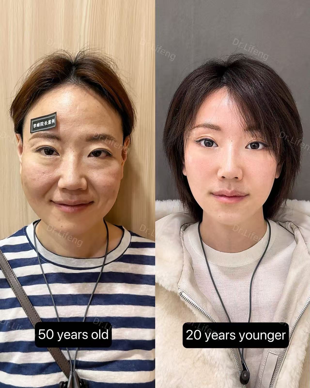 Dr. Li Feng Periorbital Rejuvenation Before and After 3 Months
