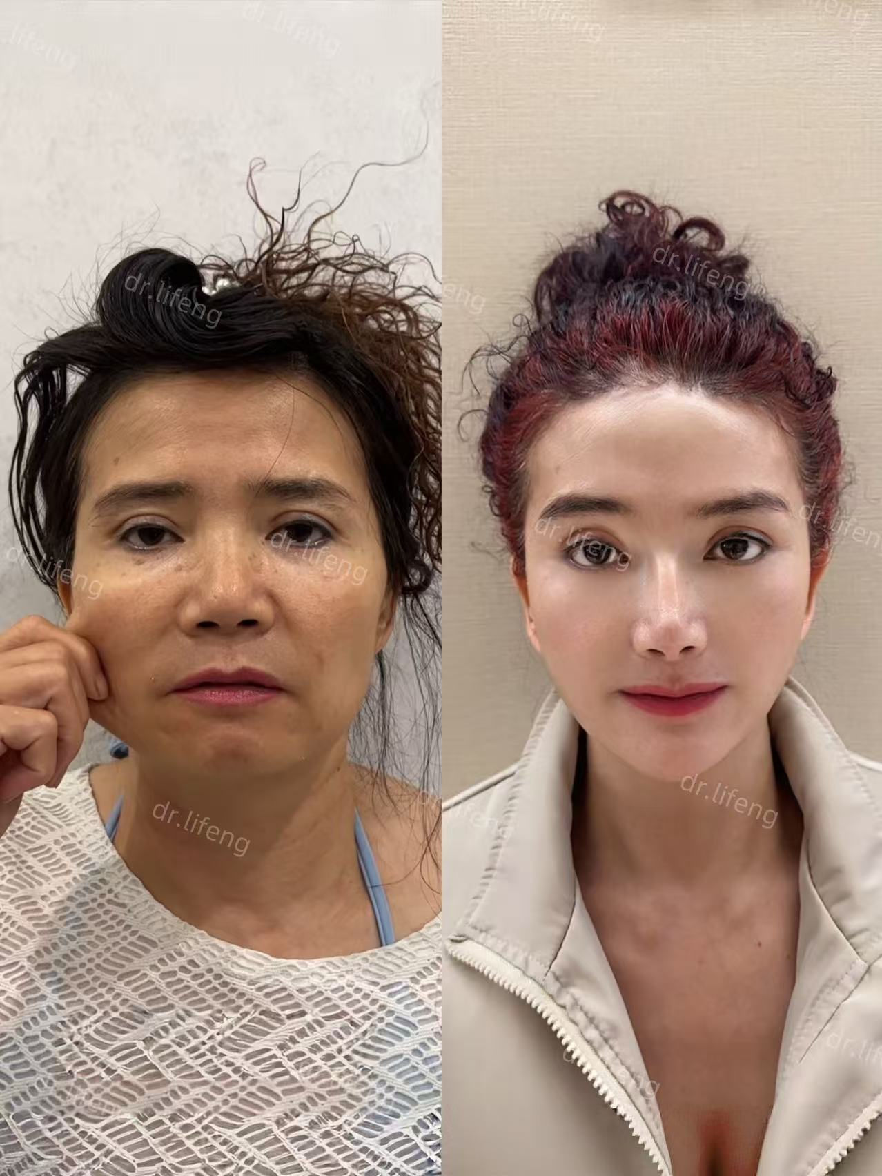 Dr. Li Feng SMAS Deep Lift Before and After 24 Months