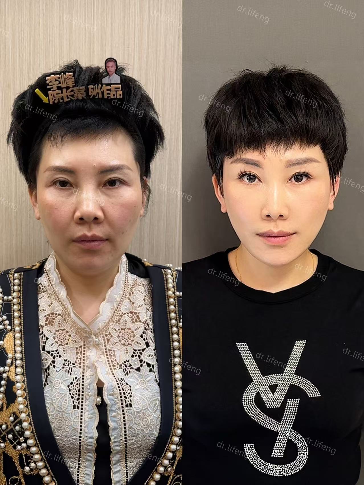 Dr. Li Feng Mid-Lower Face Lift Before and After 9 Months